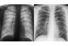 9567-tuberkulez.jpg