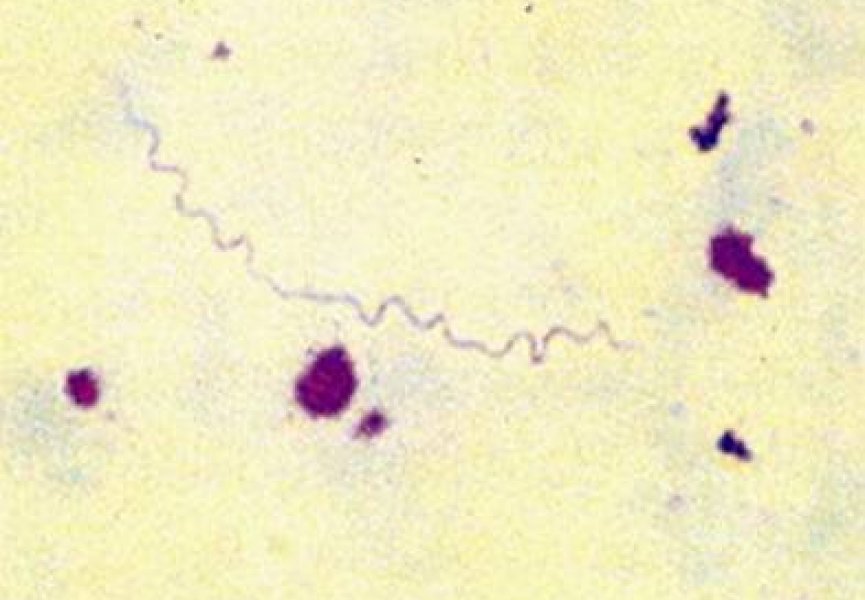 ДНК древних младенческих останков поможет детальнее изучить сифилис