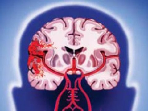 Гамартин защищает мозг от последствий инсульта