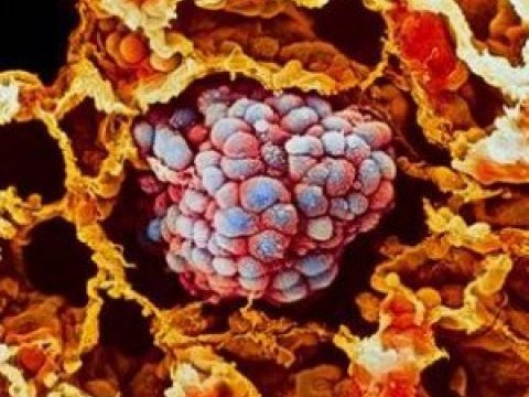 Ученые создали новую технологию диагностики рака легких